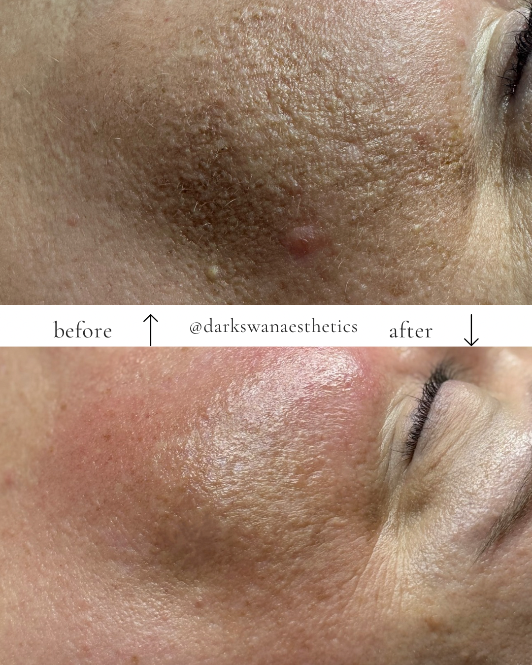 BIORE PEEL SERIES — Get the 4th Peel FREE