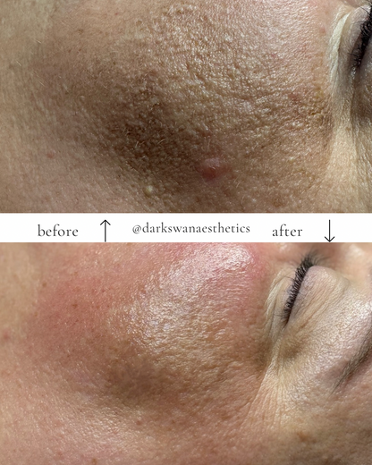 BIORE PEEL SERIES — Get the 4th Peel FREE